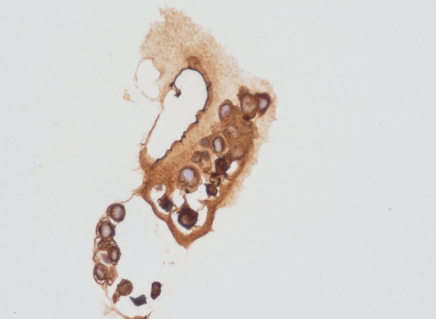 Pan-CK positive Lung CAF spheroid generated with TM600