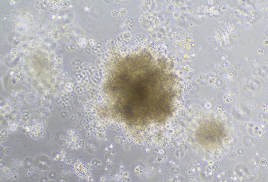 Patient-derived tumour organoid example